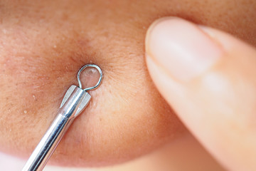 Fototapeta premium Pressing pimples , removing pimple from face, Zoom macro.