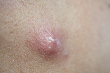 Fototapeta premium pimple extreme on human skin, large pimple, Zoom macro.