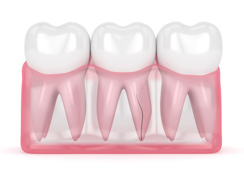 Причины опухоли десны Наиболее распространенной причиной отека является экстракц