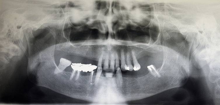 Orthopantomography of an adult patient,digital radiographic acquisition