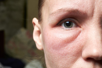 Swollen face of a woman under the eyes, swelling. An allergic reaction to drugs, cosmetics.