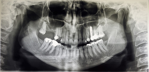 Orthopantomography of an adult patient,digital radiographic acquisition
