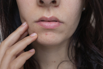 Young brunette caucasian girl with a pimple on her chin, touching her face with a concerned look, realistic image
