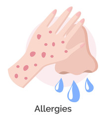Allergies symptoms, isolated icon of allergic reaction. Sickness or illness caused by allergies. Dangerous infection, rash on hands and runny nose. Result of disease, vector in flat style illustration