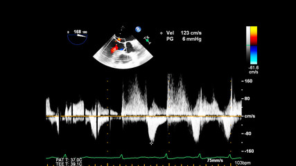 Image of the heart during transesophageal ultrasound with Doppler mode.