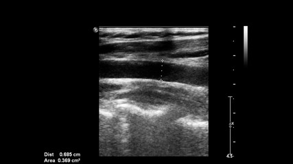 Ultrasound examination of blood vessels in grayscale mode.