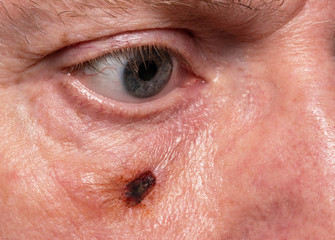 Fototapeta premium Wound on causian male cheek after removal of suspected skin cancer spot