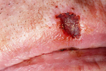 Fototapeta premium Wound on caucasian male upper lip after removal of skin suspected cancer spot