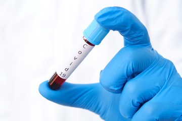 Hands wearing blue gloves, holding a test tube. The covid-19 virus sample is in the disease control laboratory. In order to study the method of treating the infected