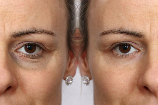 Comparison between before and after showing the results of skin treatment