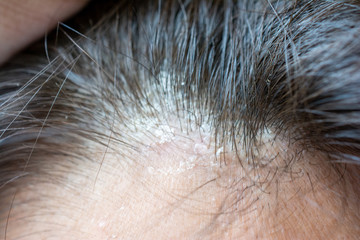 Dandruff seborrhea problem of scalp and hair treatment of peeling from allergies. Scalp dermatoses....