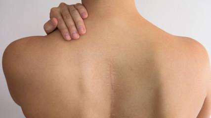 Naked back of woman with the scar along the length of the spine.