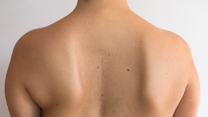 Old operation scar on the back of a young woman. Operated back. Spine surgery. Scoliosis of the...