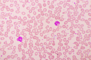 Essential thrombocytosis blood smear, present abnormal high platelet and neutrophil cell, analyze by microscope
