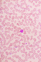 Essential thrombocytosis blood smear, present abnormal high platelet and neutrophil cell, analyze by microscope