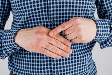 Man with sick hands, dry flaky skin on his hand with vulgar psoriasis, eczema and other skin diseases such as fungus, plaque, rash and blemishes. Autoimmune genetic disease