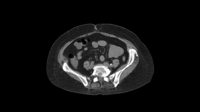 MRI of the abdominal cavity, gastrointestinal tract, bladder