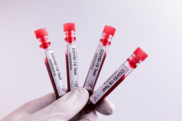 Four blood samples tested for COVID-19 coronavirus - all patients tested positive for the aggressive virus. Health concept.