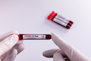 Blood samples tested for COVID-19 coronavirus - All patients tested positive for the aggressive virus. Health concept.