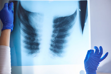 X-ray of the lungs in the hands of a medical professional