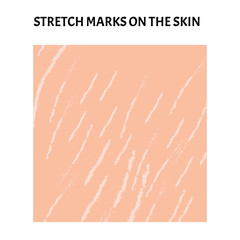 Stretch marks on the skin. Background stretch marks on the skin. Infographics. Vector illustration