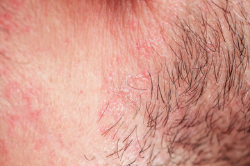 Fototapeta premium skin texture of the neck and cheeks of a young man covered with hair and beard bristles and irritation and scales