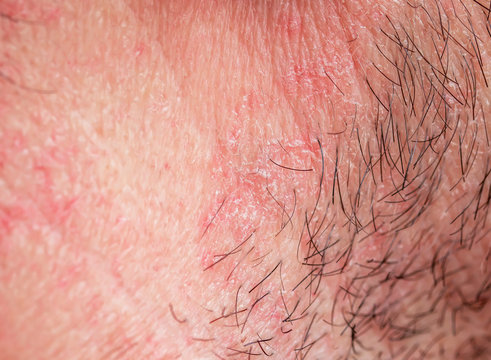  skin texture of the neck and chin of a young man covered with hair and beard bristles and irritation and scales