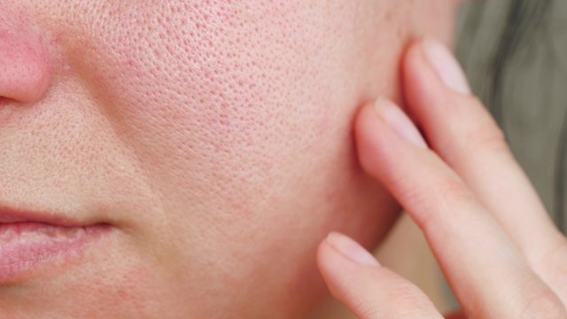Macro skin with enlarged pores. The girl touches the irritated red skin with her fingers.