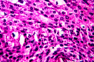 Squamous cell carcinoma of the uterus, light micrograph
