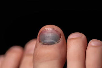 Blue toenail. Broken finger. Close up of child's injured foot. Colorful fingernail on blurry background.