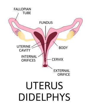 The shape of the uterus, the female reproductive organ. uterus unicornis