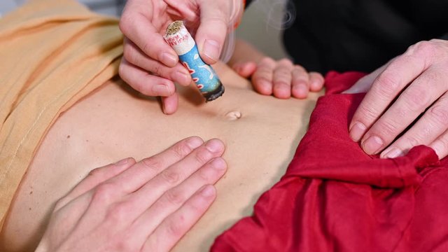 Alternative therapist applying moxibustion a traditional chinese medicine method . 