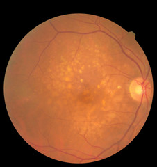 Ophthalmic image detailing the retina and optic nerve inside a healthy human eye. Health protection...
