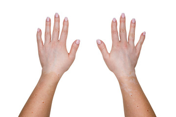 Stains from vitiligo disease on the outer parts of the hand of a young Caucasian woman, isolated on a white background with a clipping path.