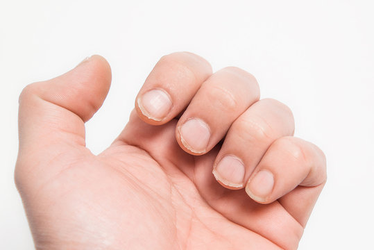 Close- Up Of Bitten And Brittle Nails. A Broken Nail On Your Finger .