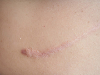 Fototapeta premium Closeup keloid scars on stomach skin after from surgery appendix (appendicitis).