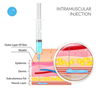 Realistic image of Intramuscular injection on a white background with the image of the structure of the skin and subcutaneous layers. Vector illustration on a medical theme
