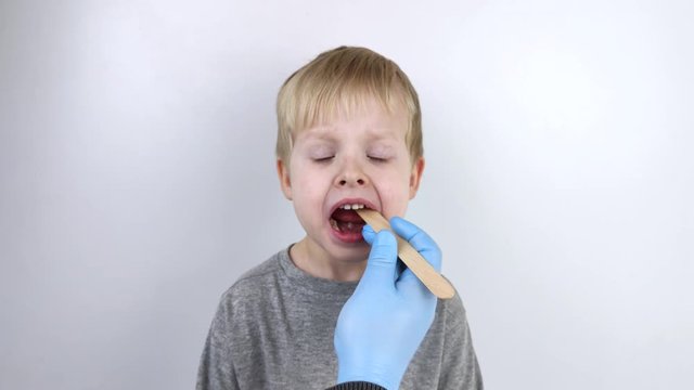 An otolaryngologist examines a child's throat with a wooden spatula. A possible diagnosis is inflammation of the pharynx, tonsils or pharyngitis.