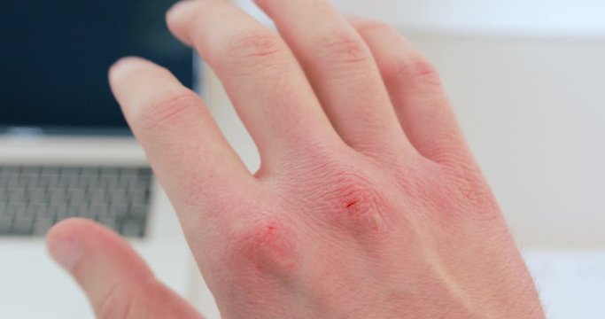 Coronavirus covid-19, mano arrossata e con ferite di medico e infermiere in ospedale dopo turni massacranti. Cura pazienti in terapia intensiva e rianimazione in Italia.