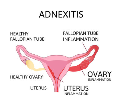 Uterus and ovaries scheme, adnexitis - infection and inflammation in the fallopian tube and ovary. Uterus inflammation.