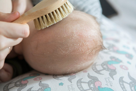 Cradle cap on a newborn child head. Parent brushing head of a child because of a cradle cap. 