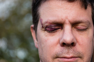 Obraz premium A white man with stubble with a purple black eye and head injury - eyes closed