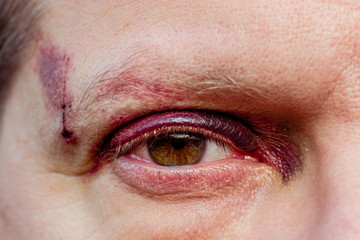 A white man with a purple black eye and head injury - eye open