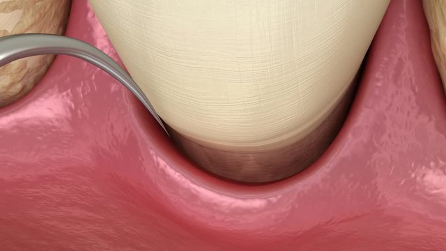 Laser hardening the blood. Medically accurate tooth 3D animation of dental treatment