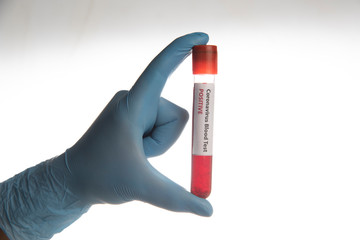 coronavirus covid-19 blood sample tube on hand 