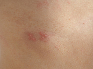 herpes zoster or shingles in woman on her skin, cause of varicella zoster virus infections symptoms...