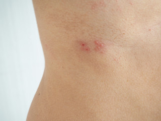 herpes zoster or shingles in woman on her waist , cause of varicella zoster virus infections...