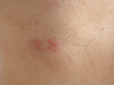 skin rash treatment on woman body. Shingles, Disease, Herpes