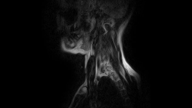 MRI of the cervical spine, detection of protrusions and hernias
