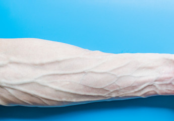 Hand of an adult with large veins